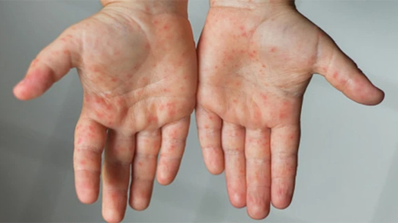 হাম ও ভাইরাসজনিত রোগ থেকে বাঁচার জন্য মাসনুন দোয়া