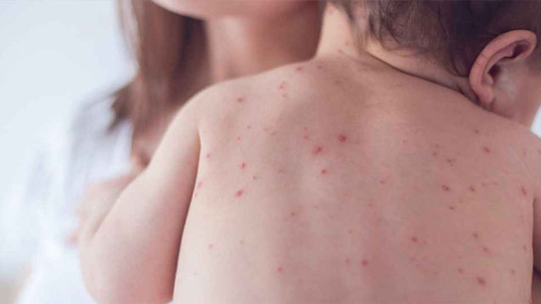 দেশে হামের প্রাদুর্ভাব বাড়ছে, সবচেয়ে ঝুঁকিতে শিশুরা...