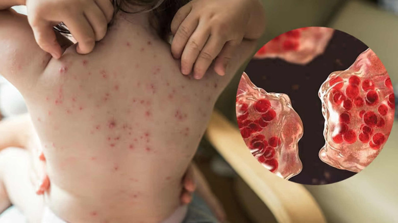 কক্সবাজারে হামের সংক্রমণ বাড়ায় এমএসএফের জরুরি সেবা